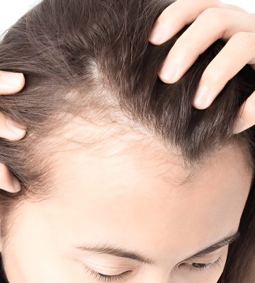Hair Thinning & Hair Loss