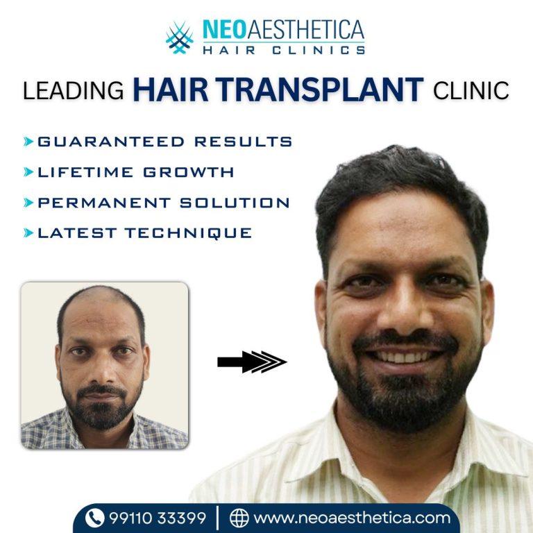 Get Best Result of Hair Transplant By Neoaesthetica 768x768