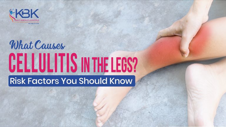 what causes cellulits  768x432