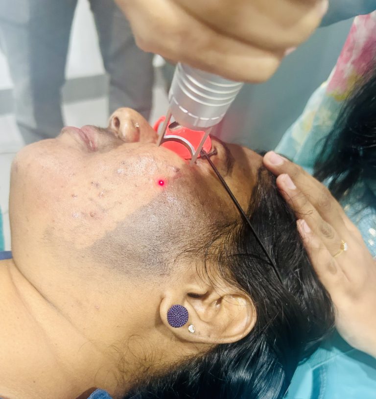 carbon laser peel dermavue coimbatore.jpg 1 768x815